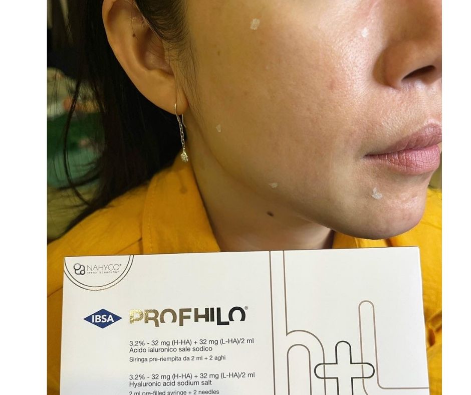 Profhilo giải pháp trẻ hóa sinh học nhờ công nghệ Nahyco Hybrid