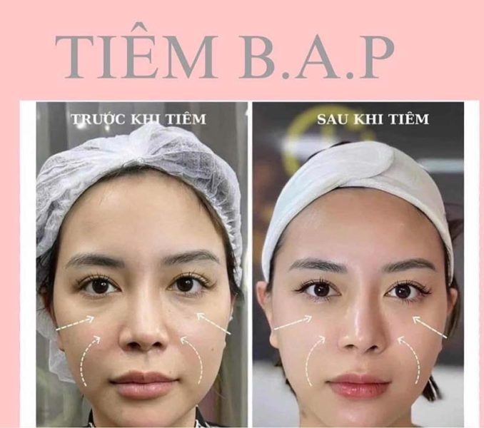 Profhilo giúp da căng mịn và đủ ẩm, còn Profhilo Structura tác động sâu hơn, phục hồi độ săn chắc, đều màu và cải thiện thể tích mô mỡ.