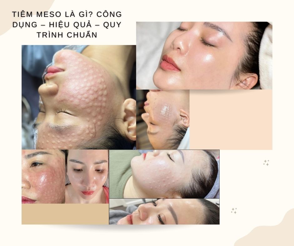 Tiêm Meso Là Gì? Công Dụng – Hiệu Quả – Quy Trình Chuẩn