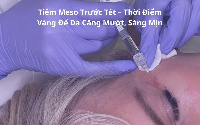 Tiêm Meso Trước Tết – Thời Điểm Vàng Để Da Căng Mướt, Sáng Mịn