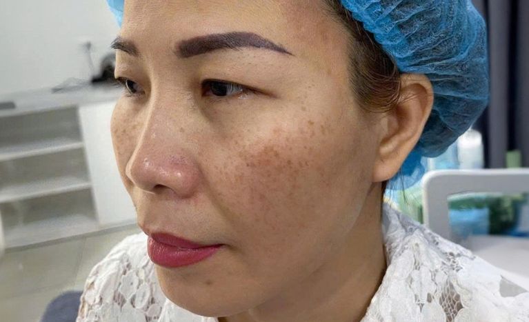 hinh anh nhan tiem meso tinh cong tai nha 21