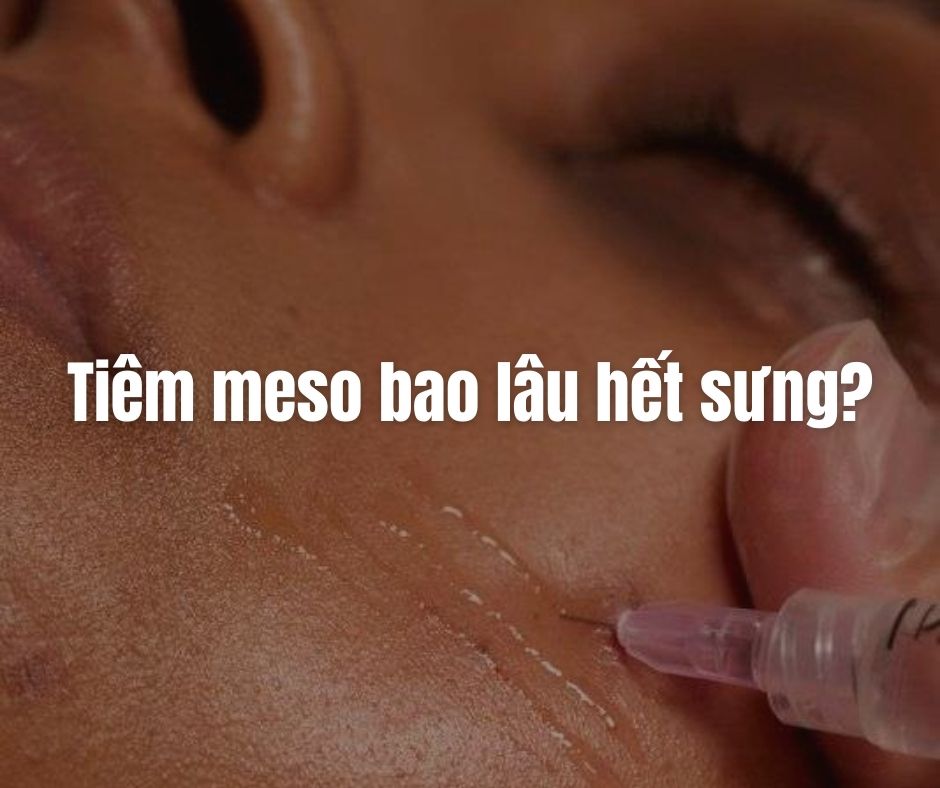 Tiêm meso bao lâu hết sưng?