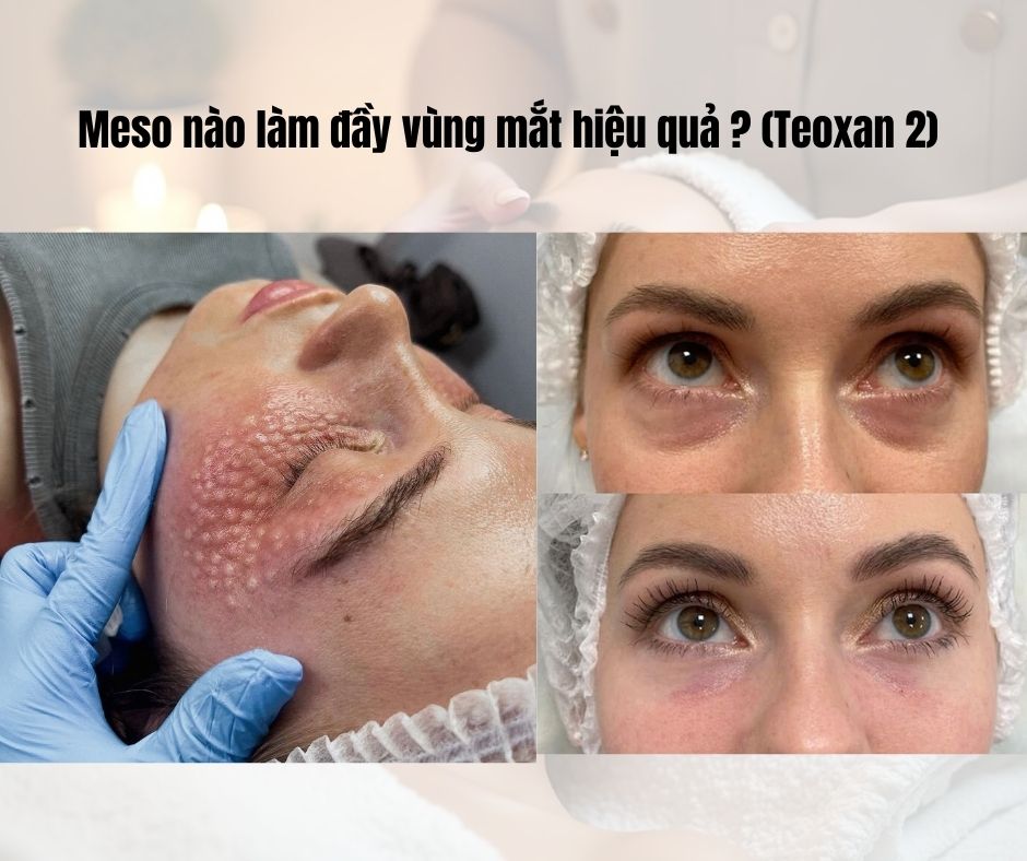 Meso nào làm đầy vùng mắt hiệu quả ? (Teoxan 2)