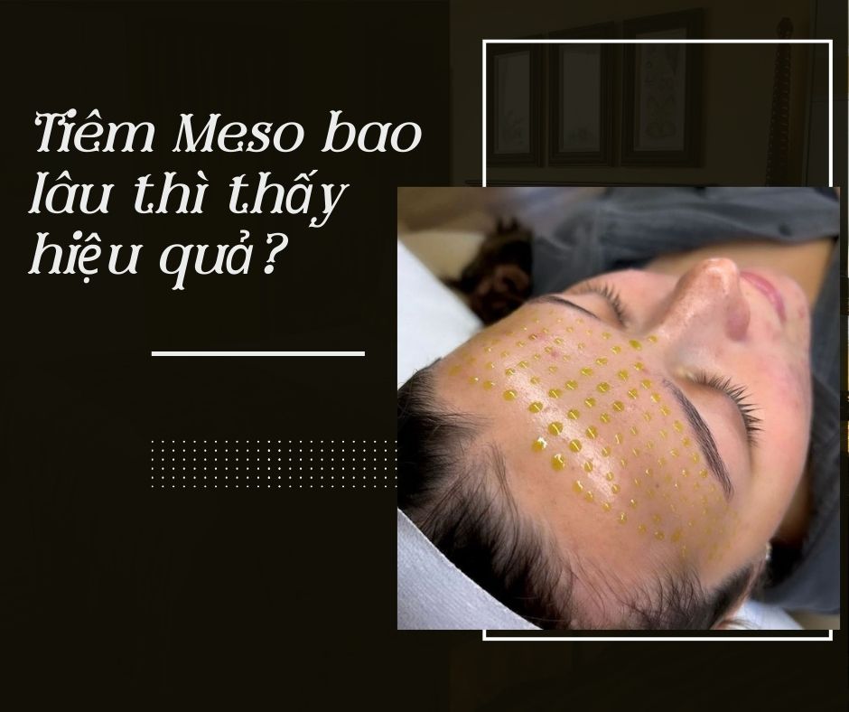 Tiêm Meso bao lâu thì thấy hiệu quả?