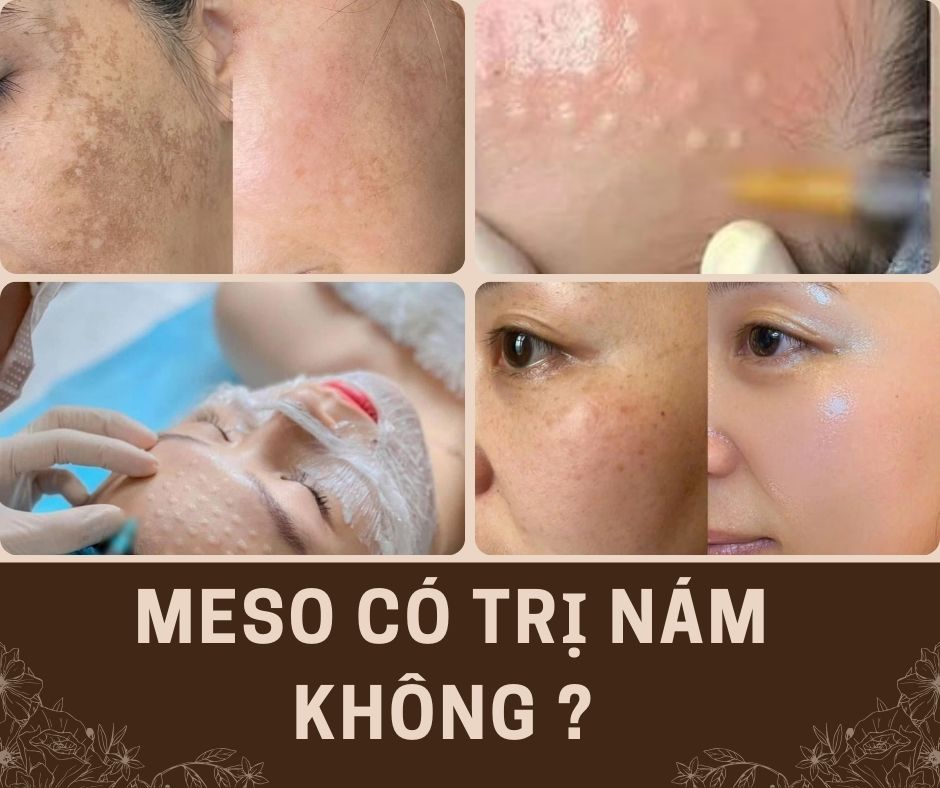 Meso có trị nám không ? (muốn hiệu quả kết hợp: bôi thoa chống nắng, uống, tiêm)
