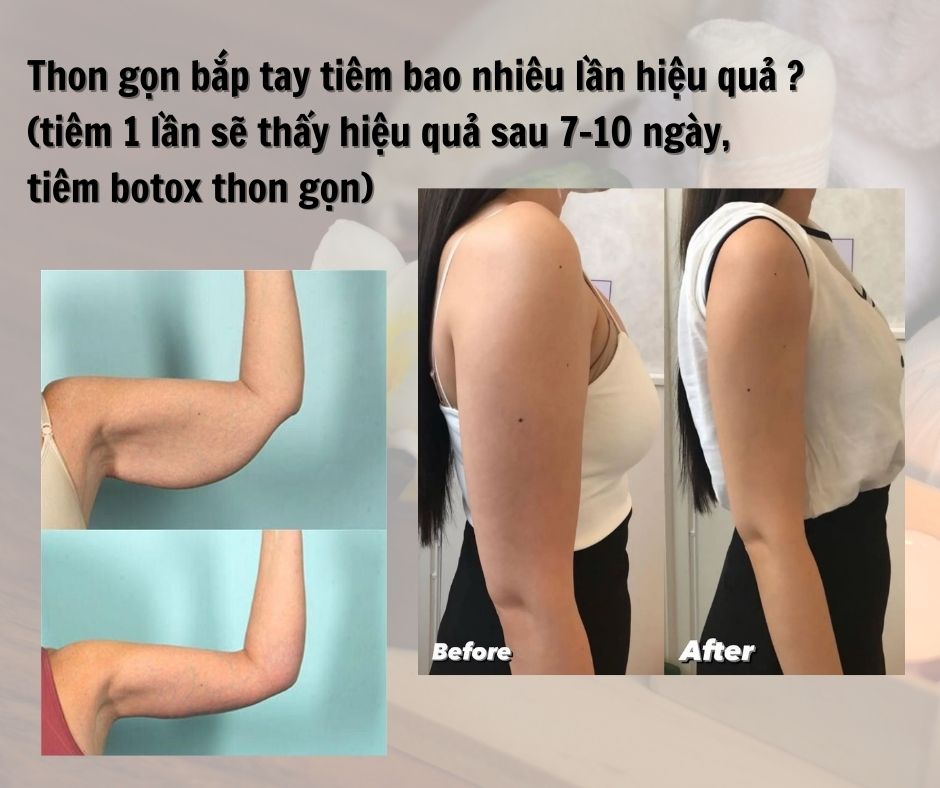 Thon gọn bắp tay tiêm bao nhiêu lần hiệu quả ?