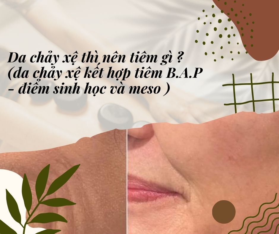 Da chảy xệ thì nên tiêm gì ? (da chảy xệ kết hợp tiêm B.A.P - điểm sinh học và meso )
