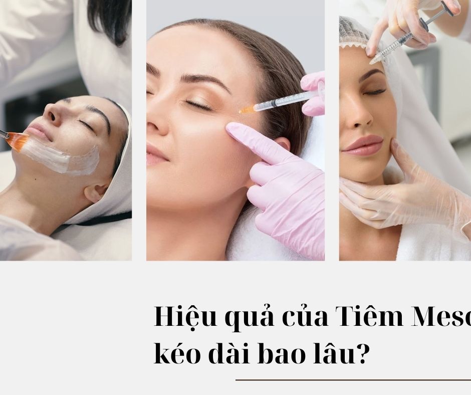 Hiệu quả của Tiêm Meso kéo dài bao lâu?
