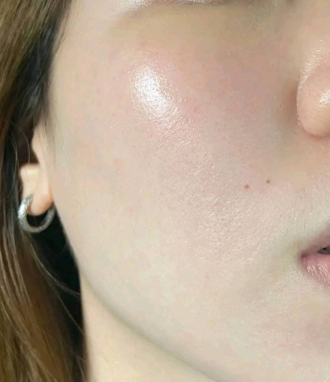 Nên tiêm mesotherapy bằng máy hay bằng tay hiệu quả hơn?