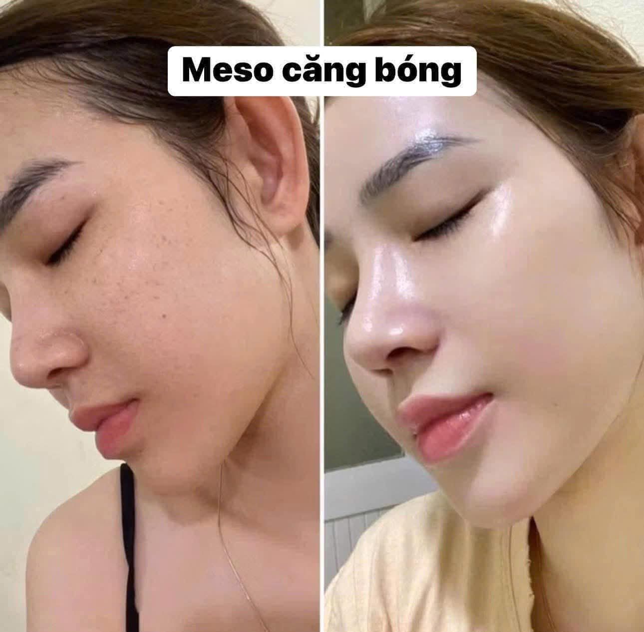 Sự Thật Về Tiêm Meso Mà Spa Ít Khi Nói Rõ