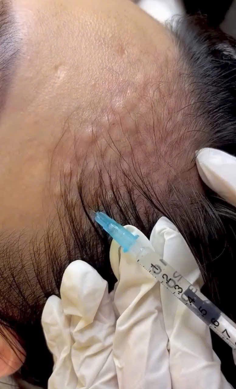 Sự Thật Về Tiêm Meso Mà Spa Ít Khi Nói Rõ