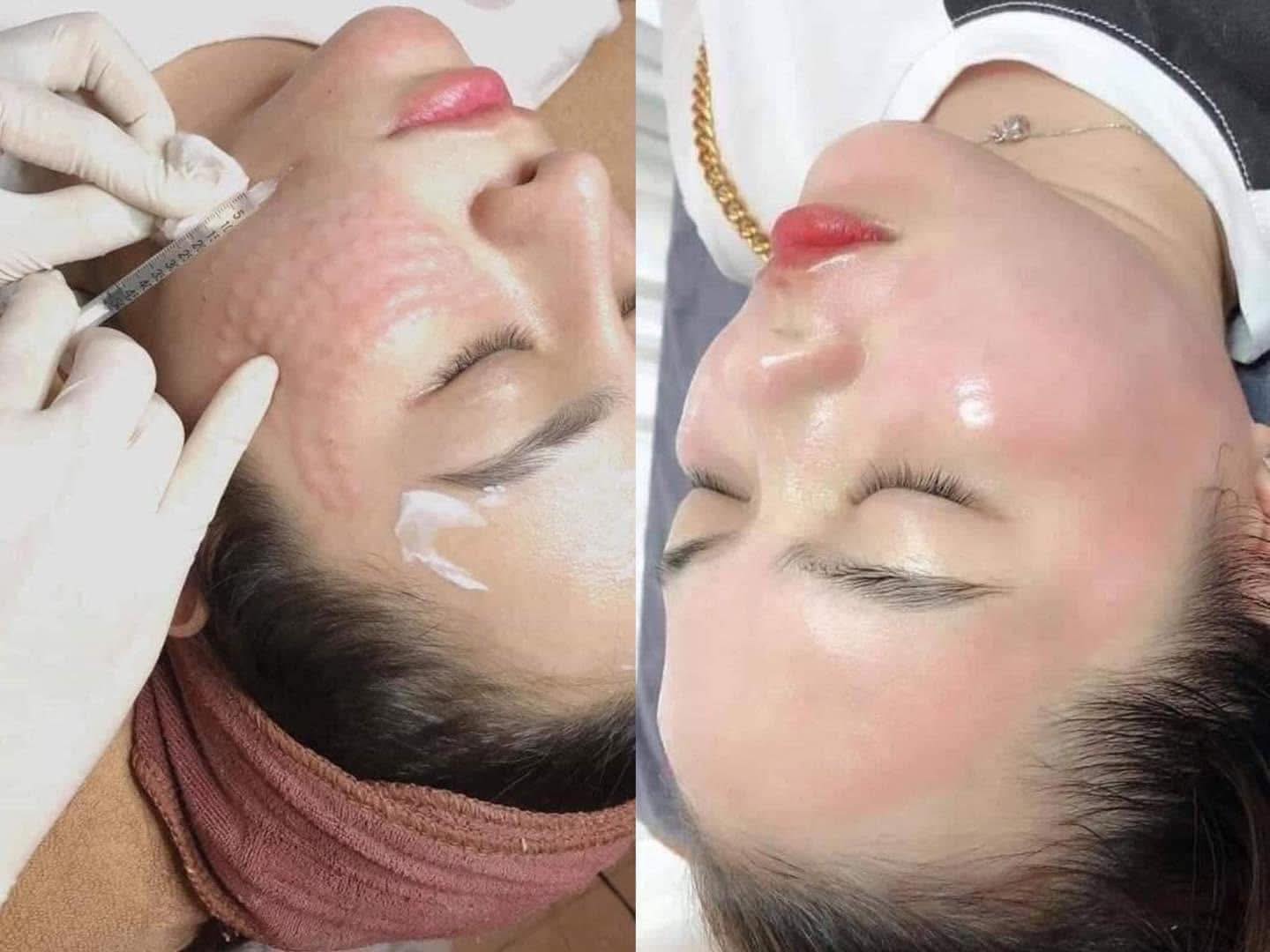 Sự Thật Về Tiêm Meso Mà Spa Ít Khi Nói Rõ