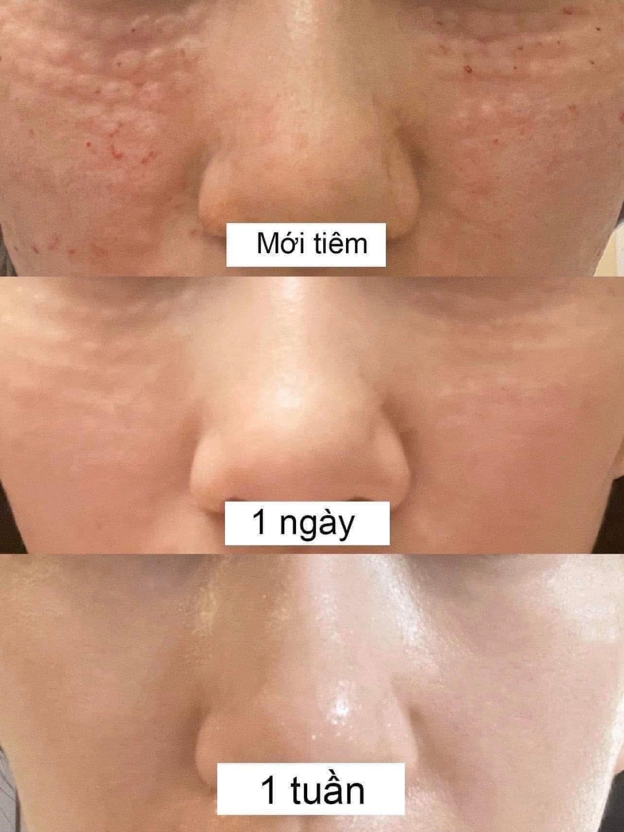 Tiêm Meso Chuẩn Y Khoa Ở Clinic Diễn Ra Như Thế Nào