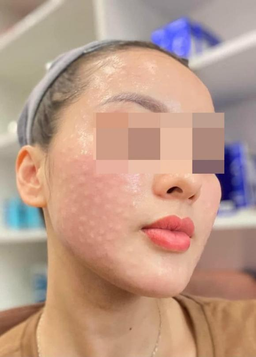 Tiêm Meso Chuẩn Y Khoa Ở Clinic Diễn Ra Như Thế Nào