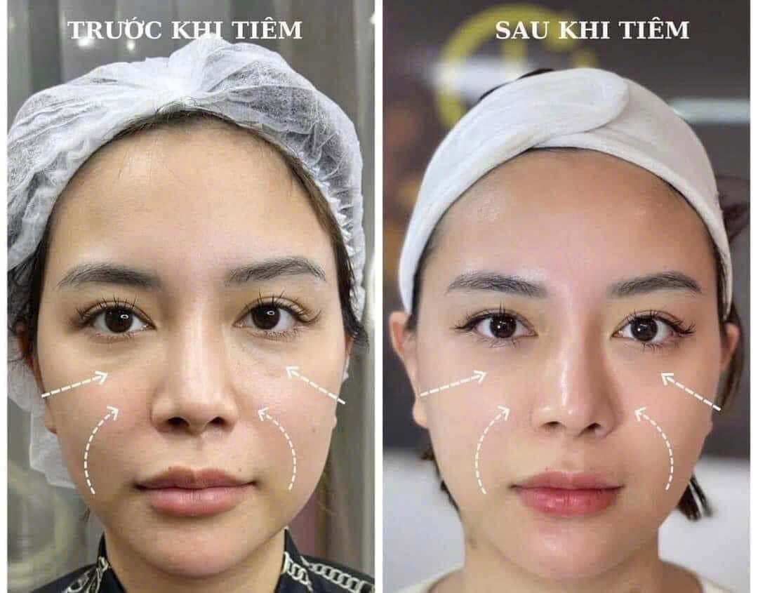 Tiêm BAP Phục Hồi Da Yếu, Da Tổn Thương