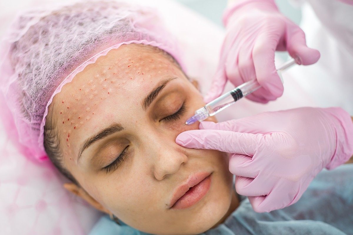 Mesotherapy Hoạt Động Như Thế Nào Trên Da?