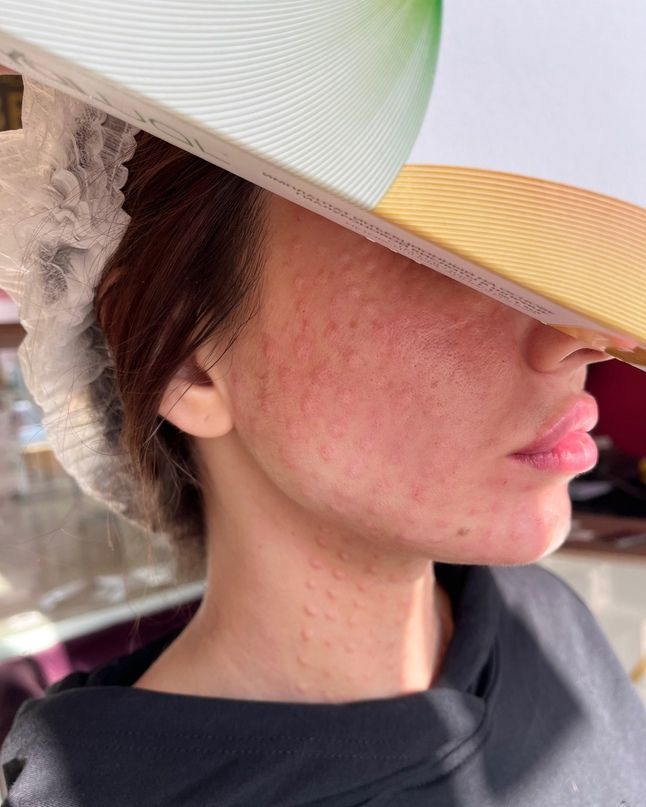 Tiêm Meso Bao Lâu Thì Trang Điểm Được?