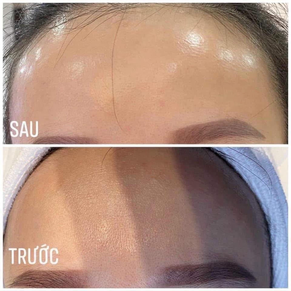 Tiêm Meso Trẻ Hóa Da Có Khiến Da Nhìn Trẻ Hơn Không