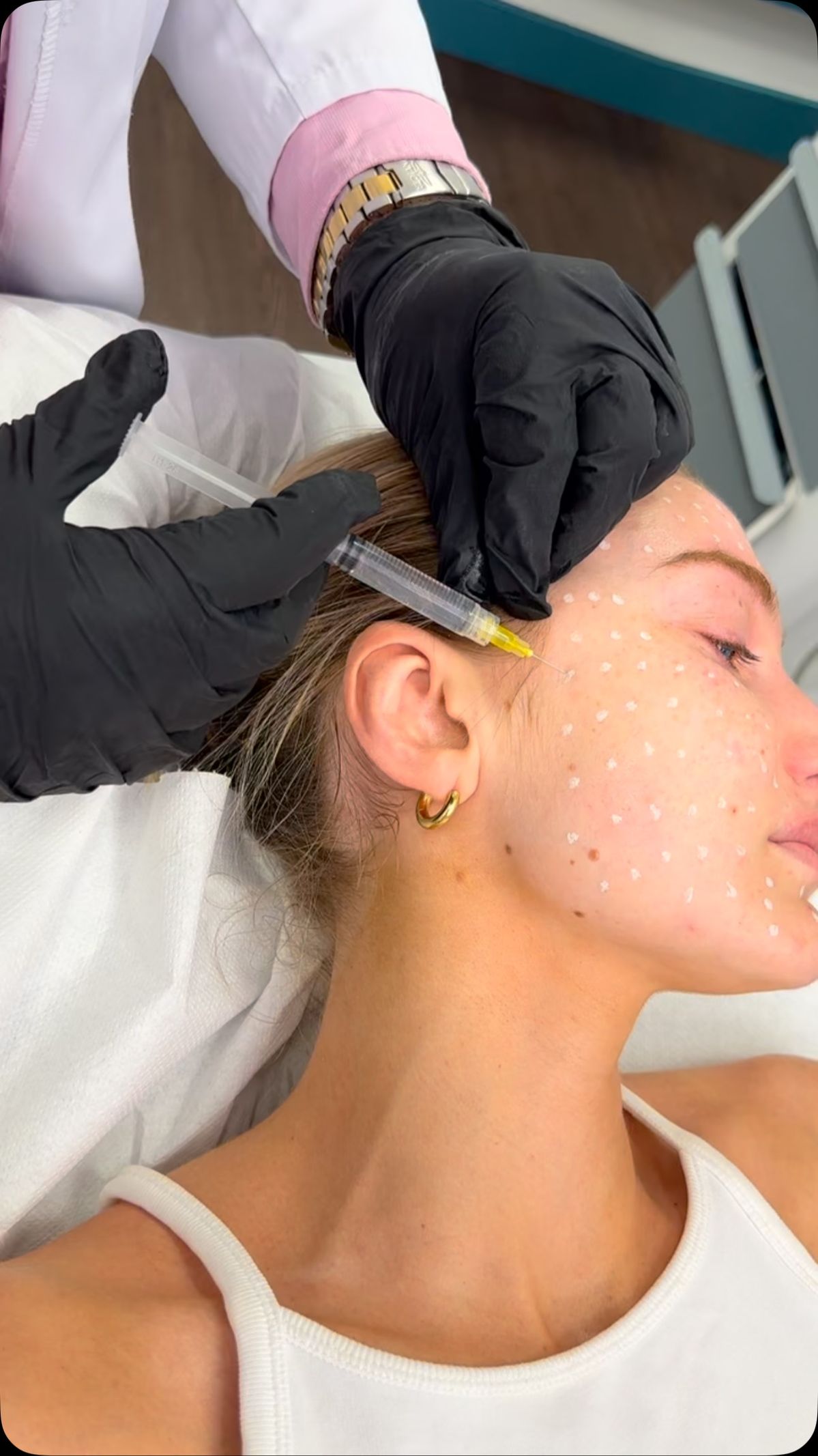 Tiêm Meso Trị Nám