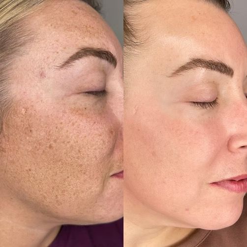 Tiêm Meso Trị Nám Bao Lâu Thì Thấy Hiệu Quả