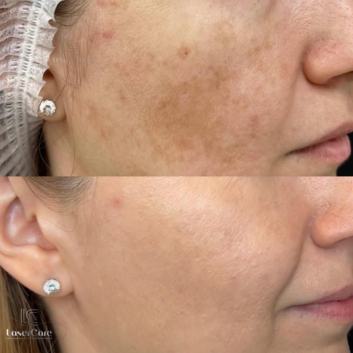 Tiêm Meso Trị Nám Hoạt Động Như Thế Nào Trên Da