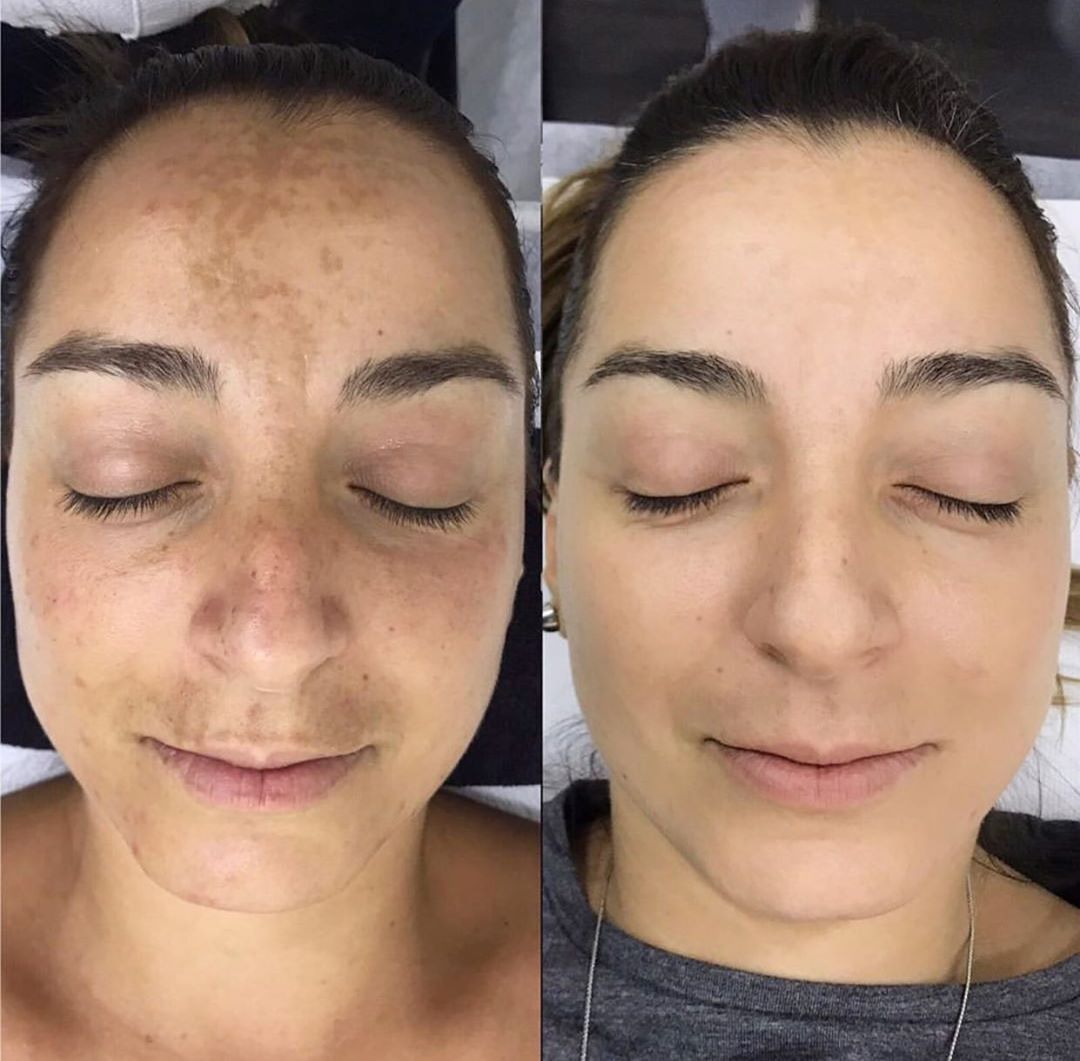 Tiêm Meso Trị Nám