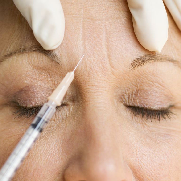 Botox Trán Có Giảm Nếp Nhăn Sâu Không