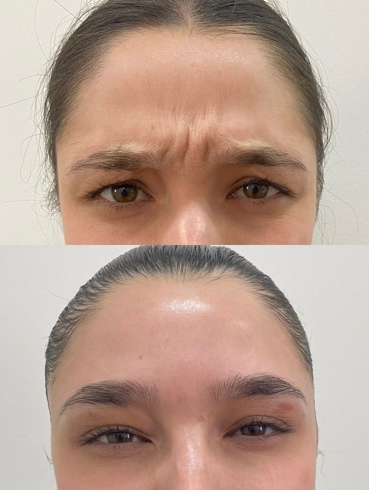 Cách Giữ Hiệu Quả Tiêm Botox Xóa Nhăn Lâu Hơn