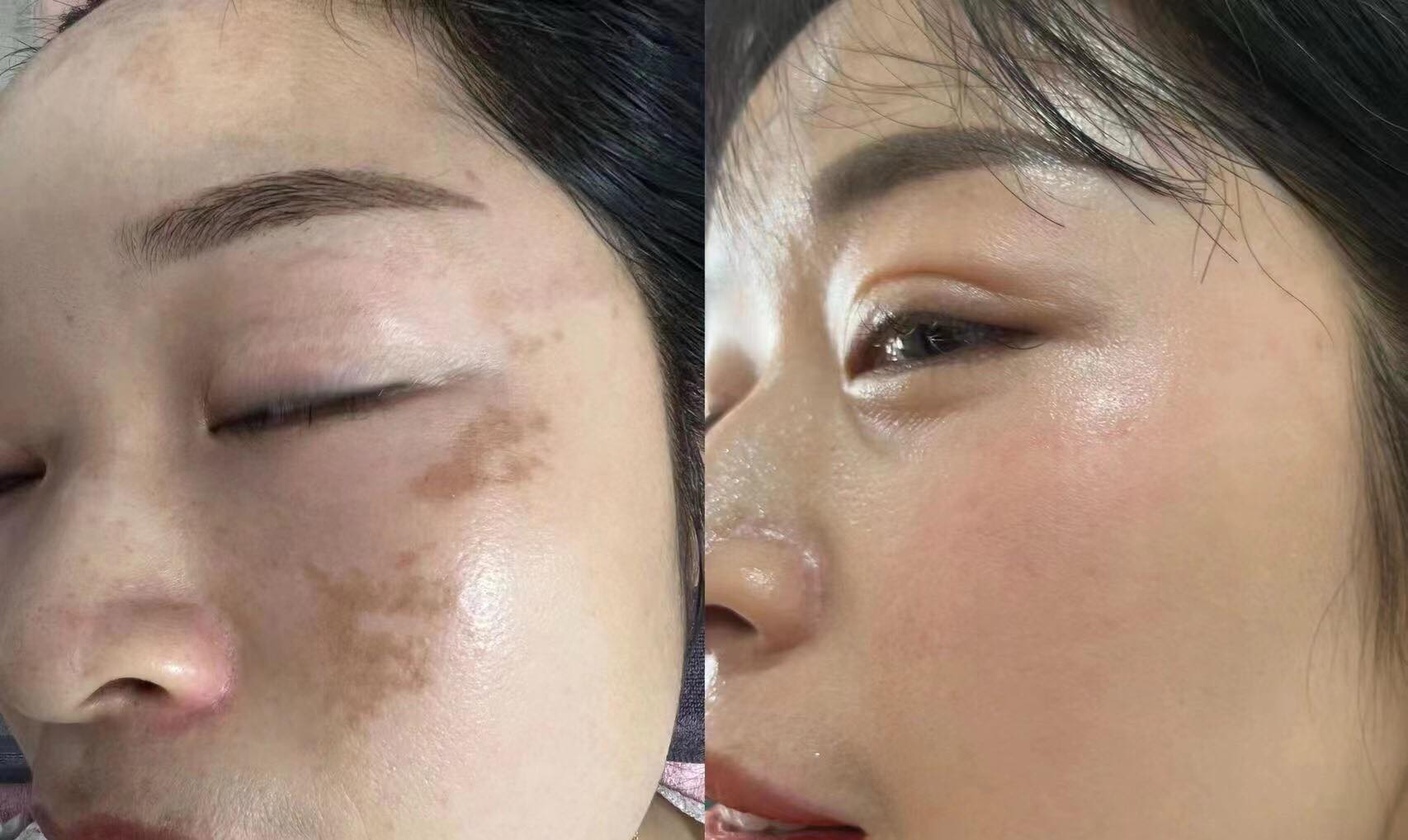 Cách duy trì hiệu quả sau meso trị thâm nám