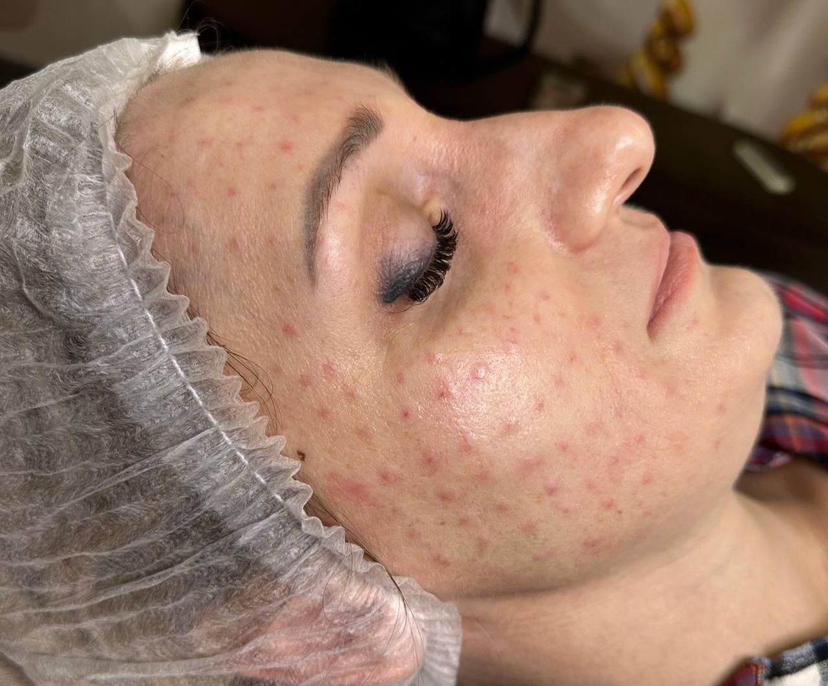 Dịch Vụ Tiêm Meso Tại Nhà Quận Gò Vấp Uy Tín