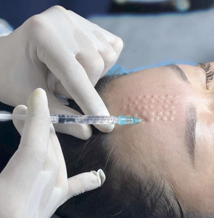 Dịch Vụ Tiêm Meso Tại Nhà Quận Gò Vấp Uy Tín