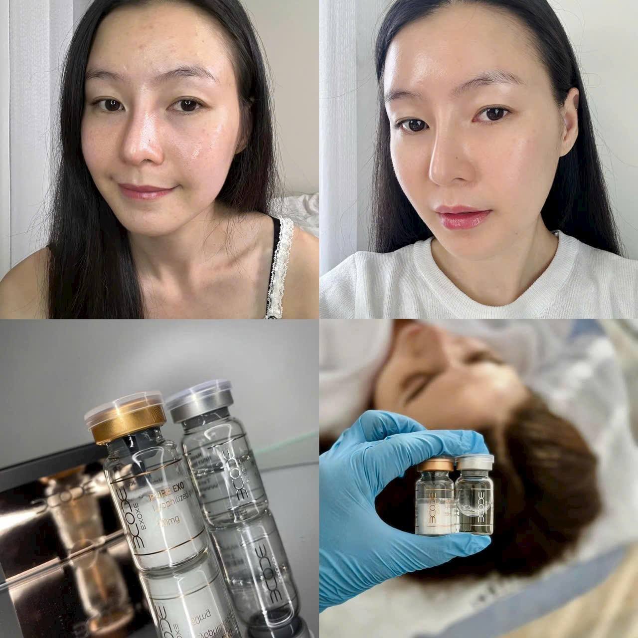 Liệu trình meso trị nám bao lâu hiệu quả