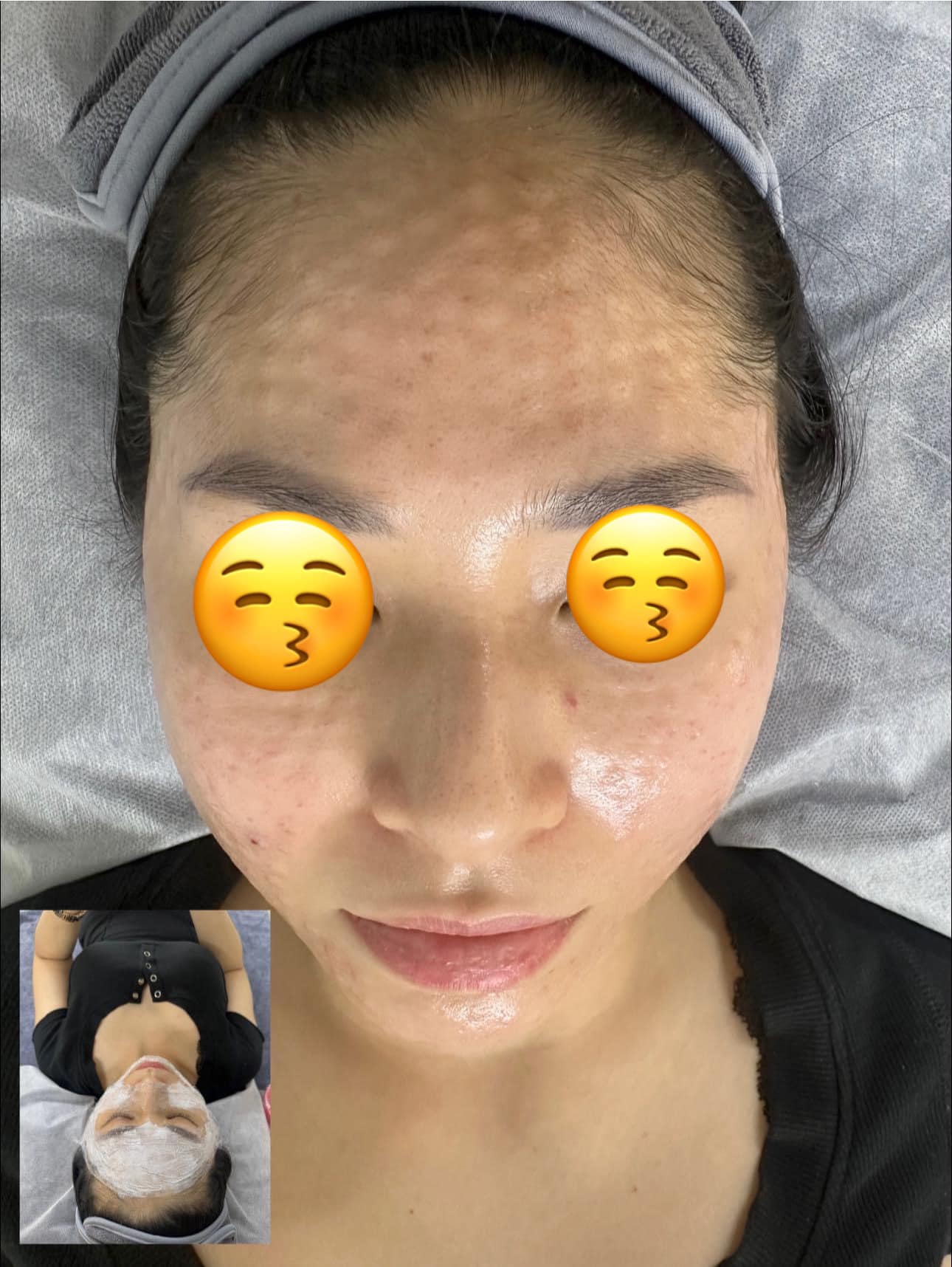 Liệu trình meso trị nám bao lâu hiệu quả