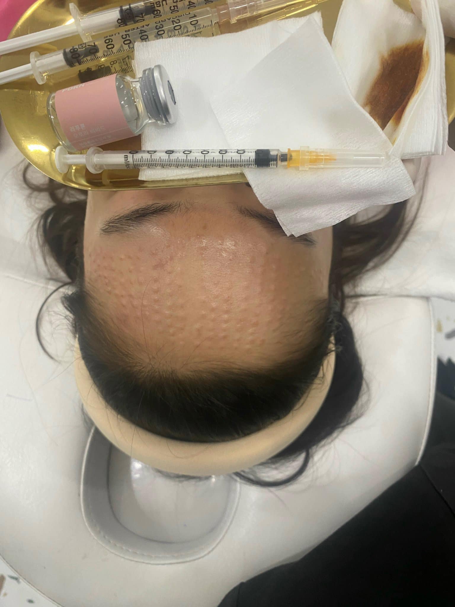 Liệu trình meso trị nám bao lâu hiệu quả