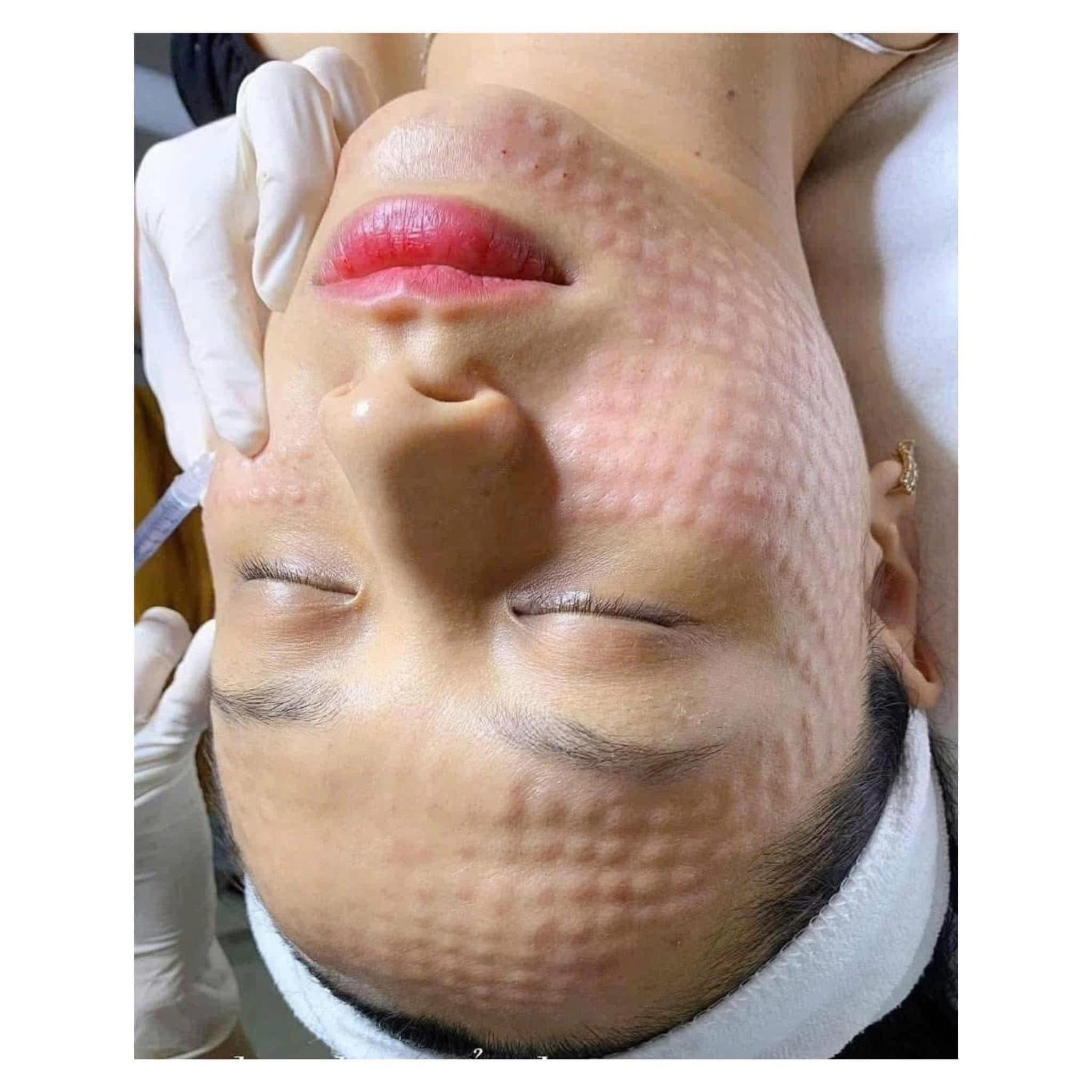 Nam Giới Có Nên Tiêm Mesotherapy Không