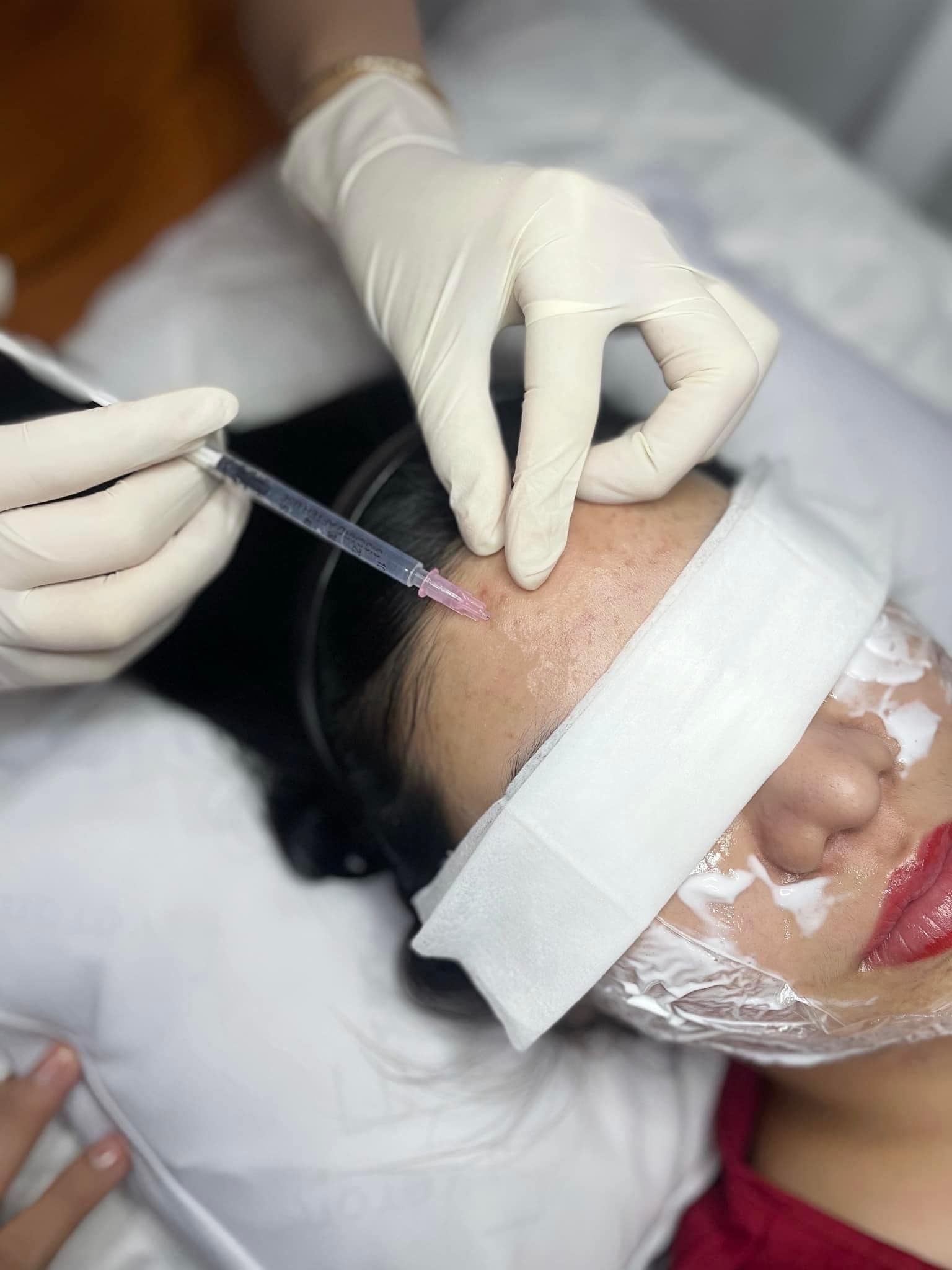 Tiêm BAP Có Hiệu Quả Hơn Meso Không