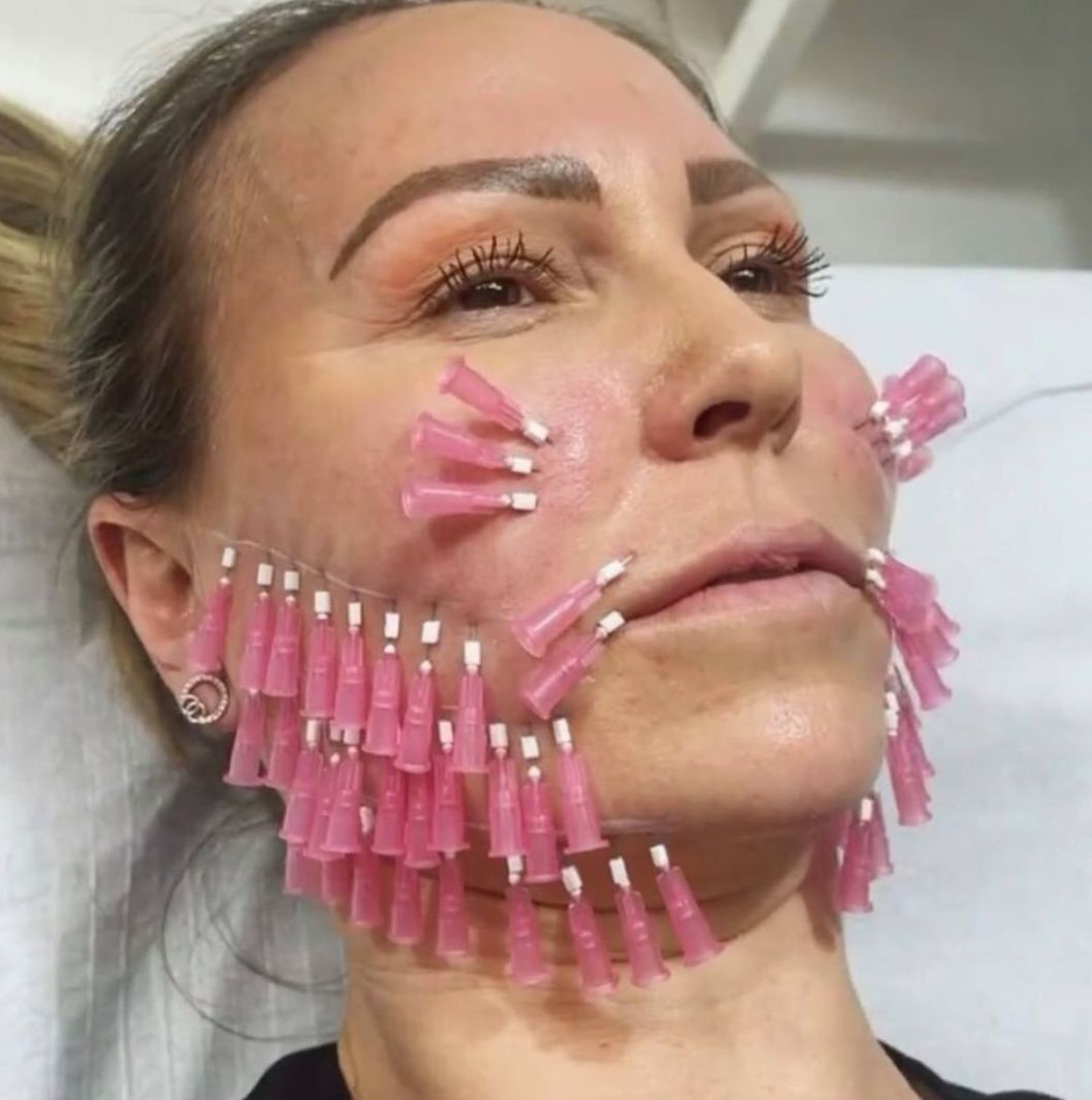 Tiêm BAP Có Thay Thế Căng Chỉ Không