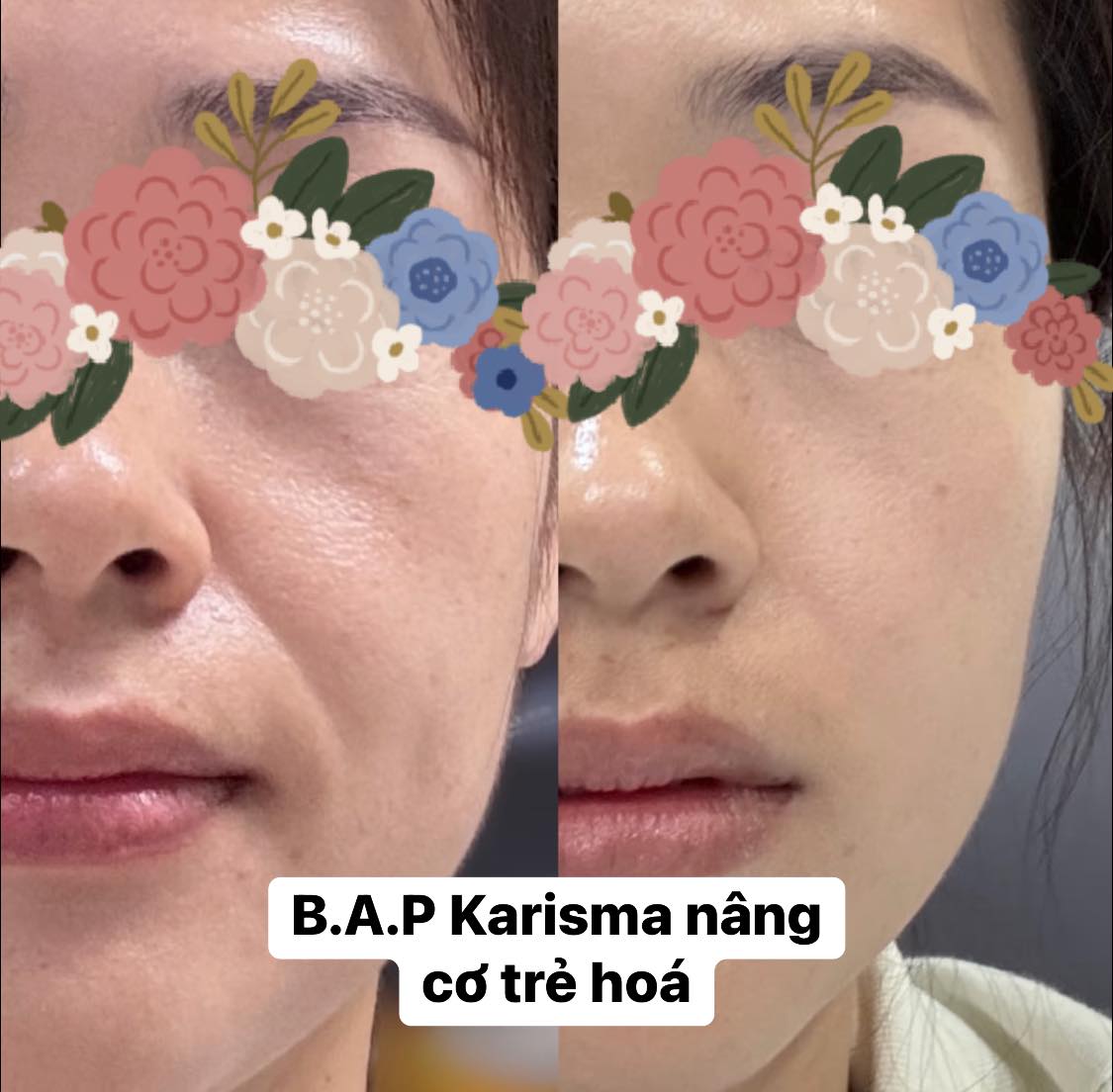 Tiêm BAP Ở Spa Hay Bệnh Viện Da Liễu Tốt Hơn