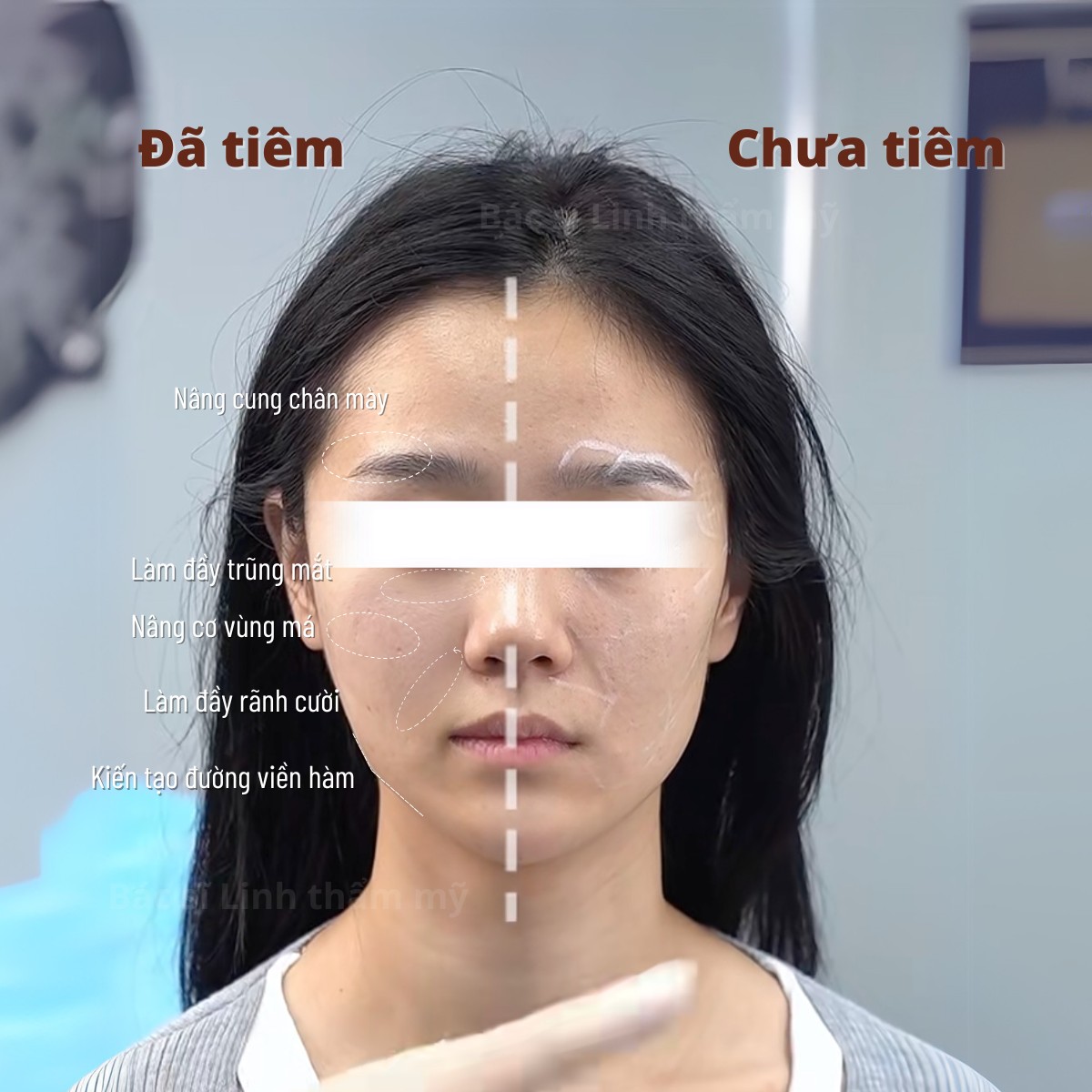 Tiêm BAP giúp xoa rãnh cười không