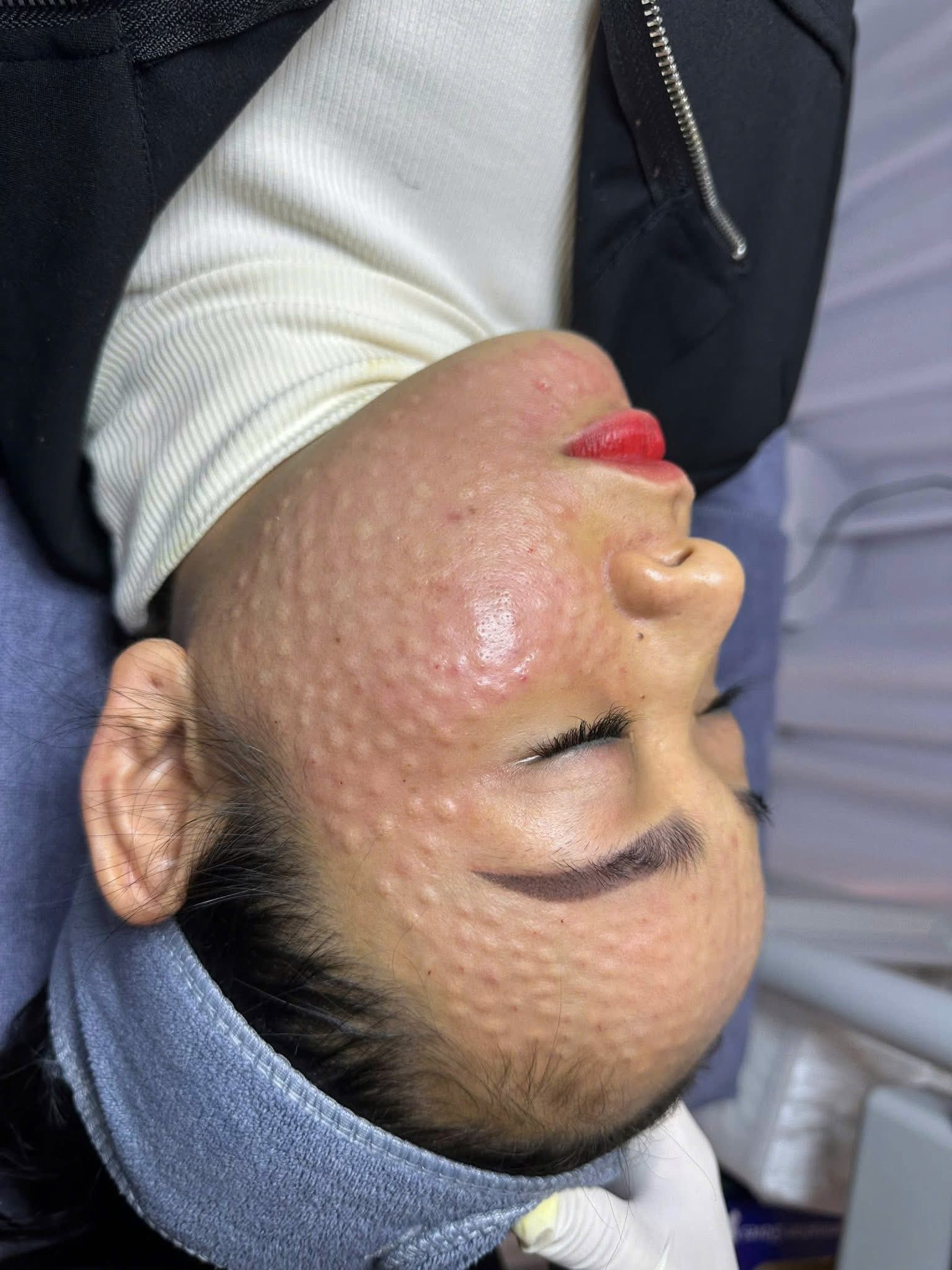 Tiêm Meso Có Làm Da Phụ Thuộc Không?