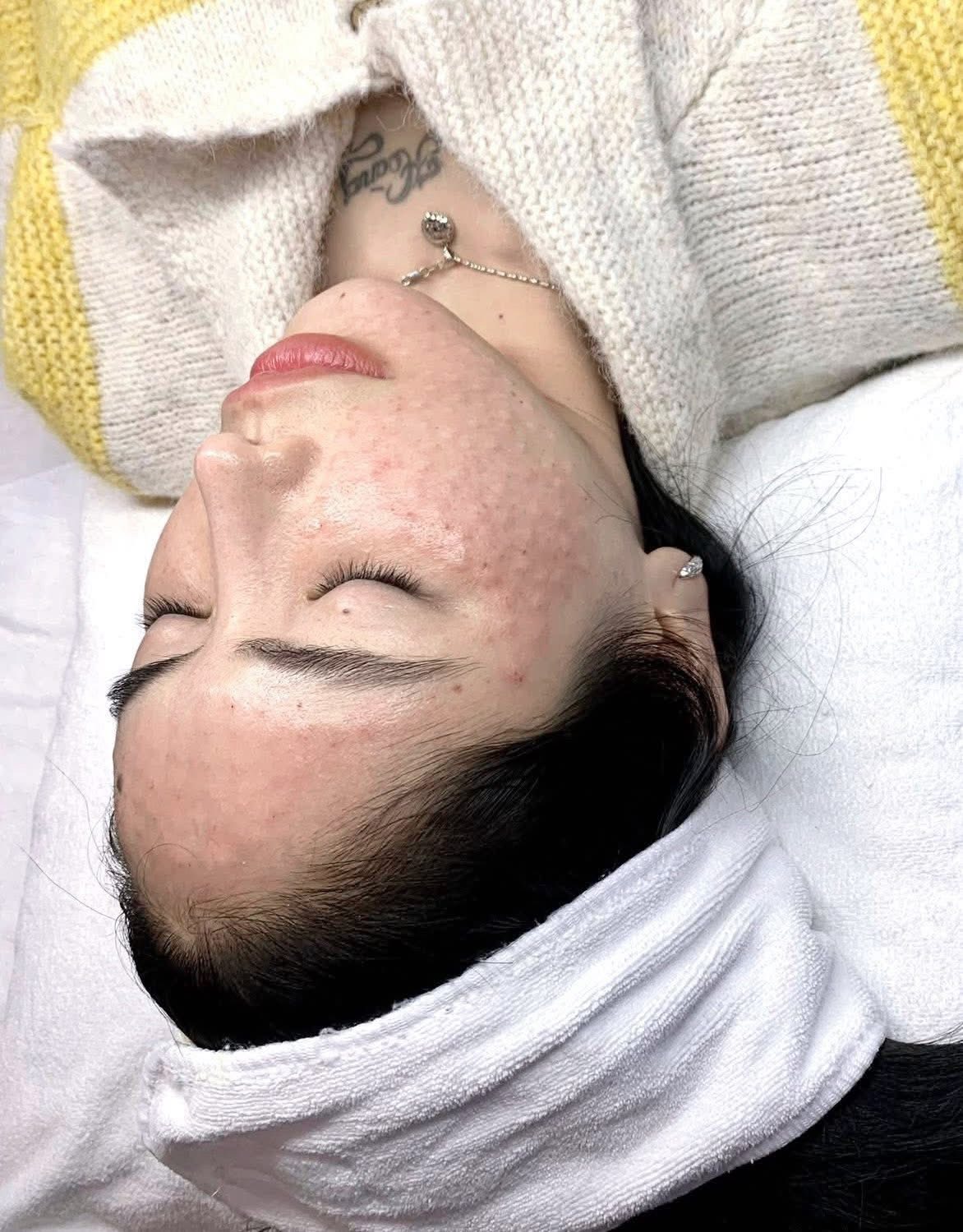 Tiêm Meso Có Làm Da Phụ Thuộc Không?