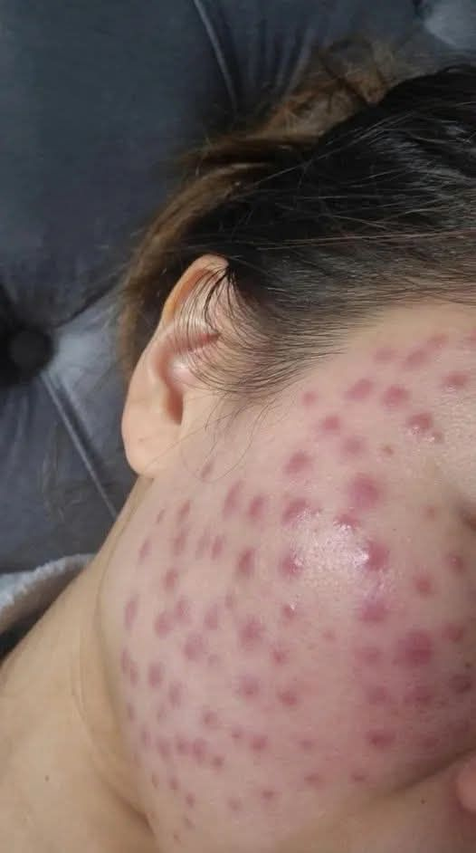 Tiêm Meso bị u hạt thì xử lý như thế nào