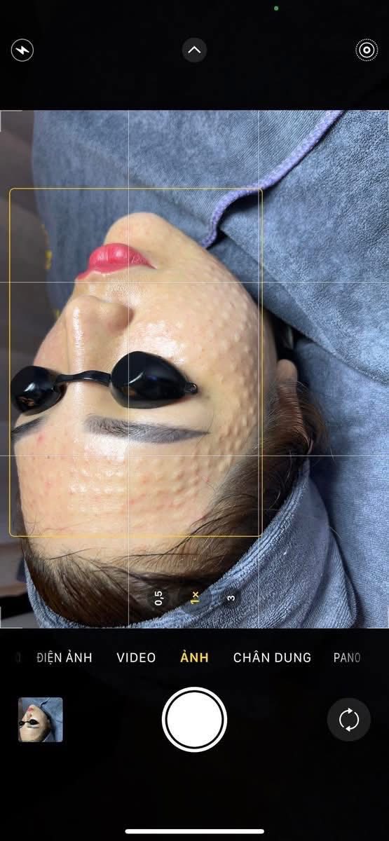 Tiêm Meso Nên Kết Hợp Gì Để Tối Đa Hiệu Quả?