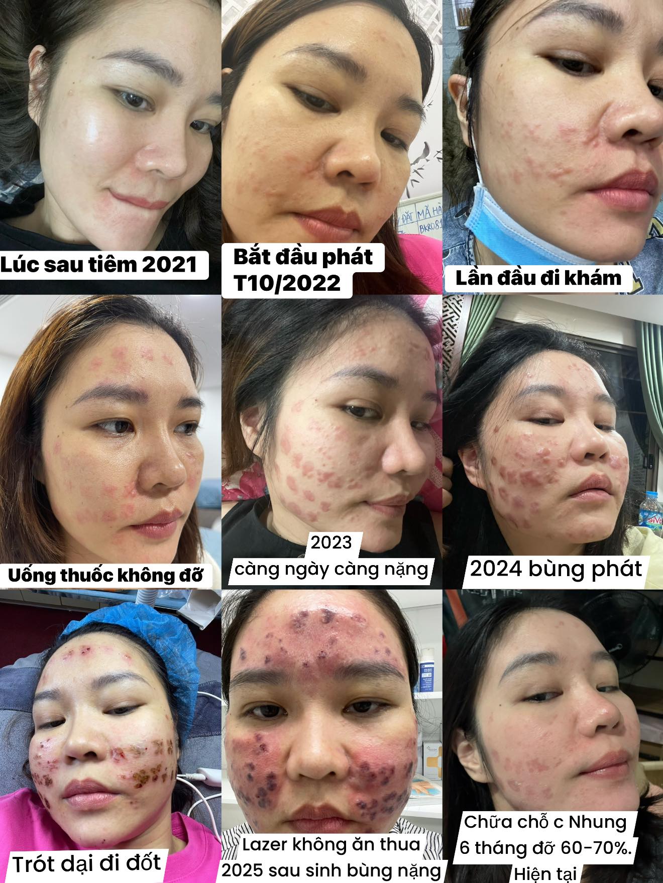 Tiêm Meso bị u hạt thì xử lý như thế nào