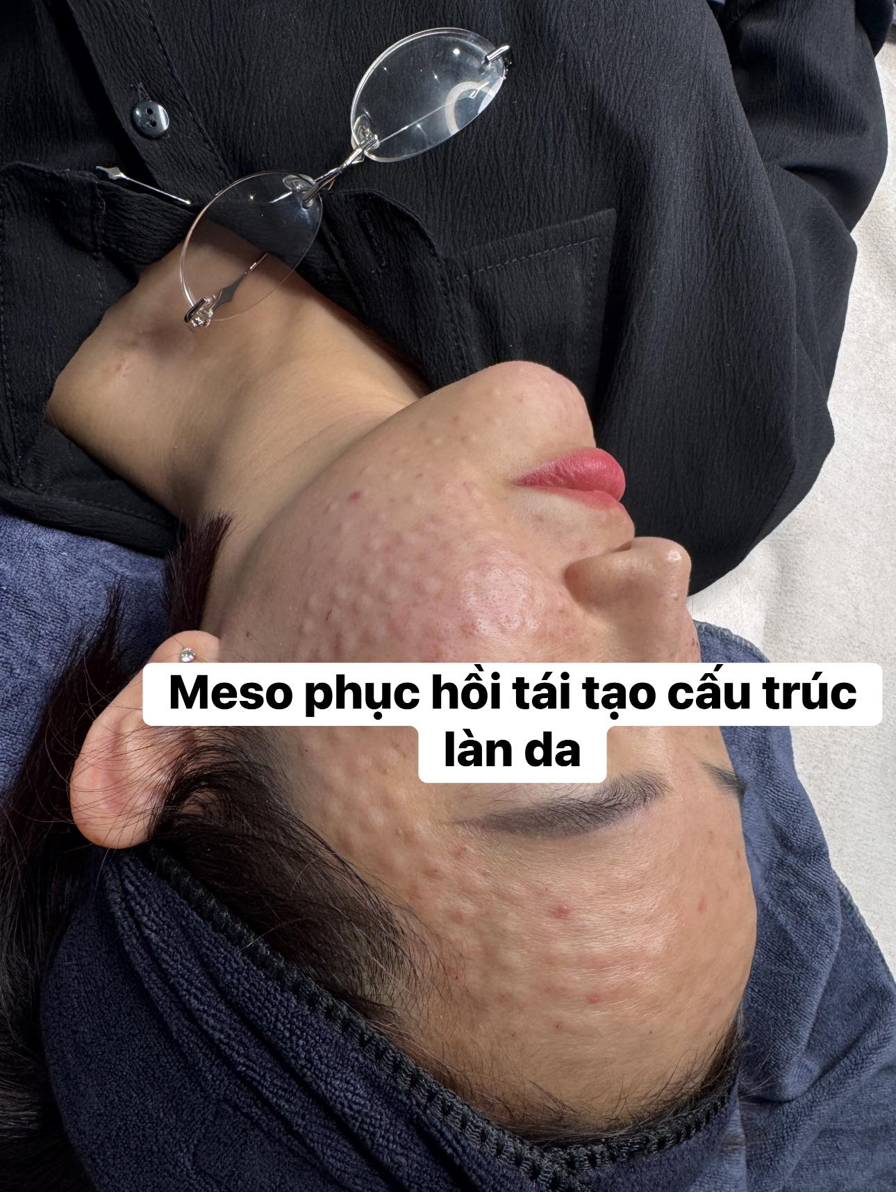 Tiêm meso giá bao nhiêu