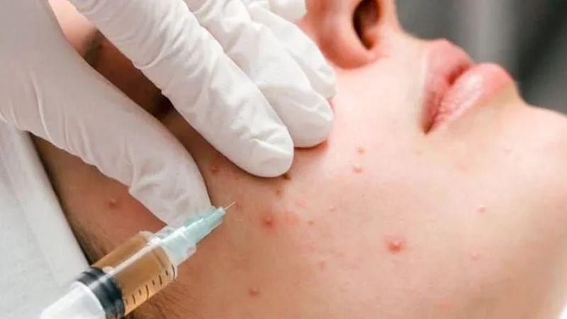 Tiêm meso trị mụn bao nhiêu lần thì hiệu quả