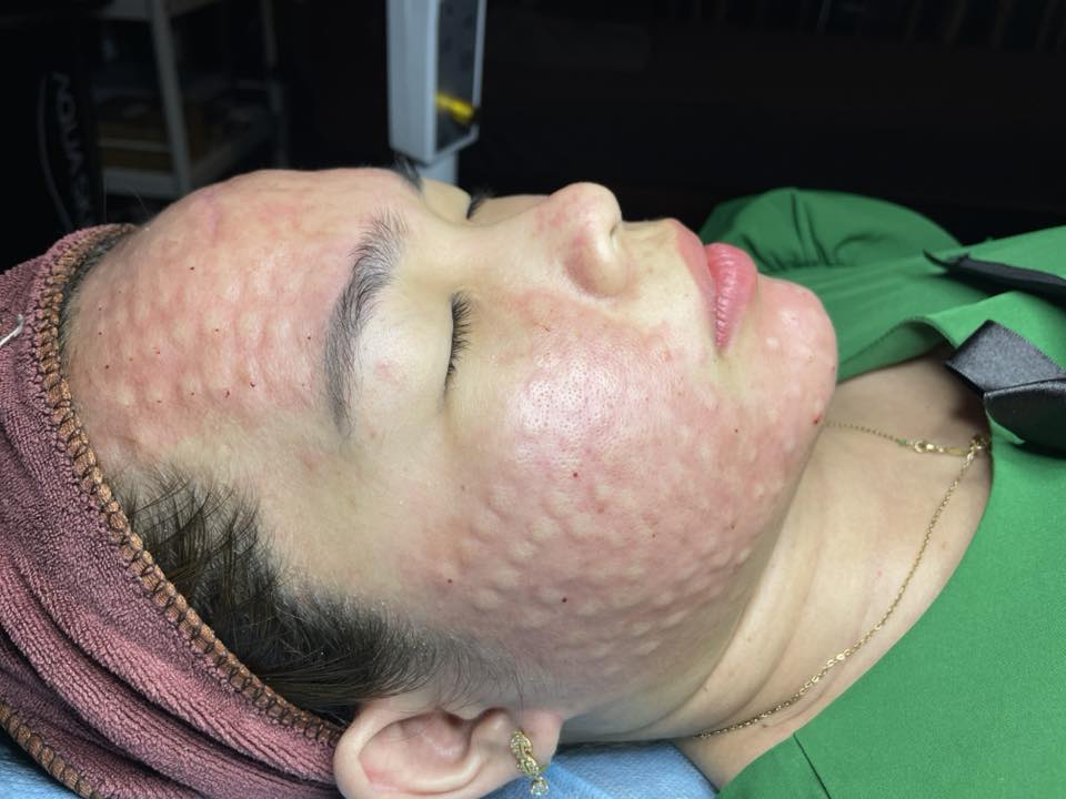 Tiêm meso trị mụn có tốt không