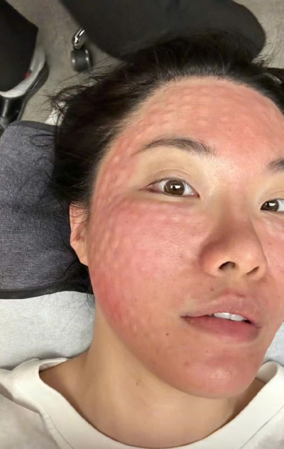 Tiêm meso trị nám có tốt hơn bắn laser không