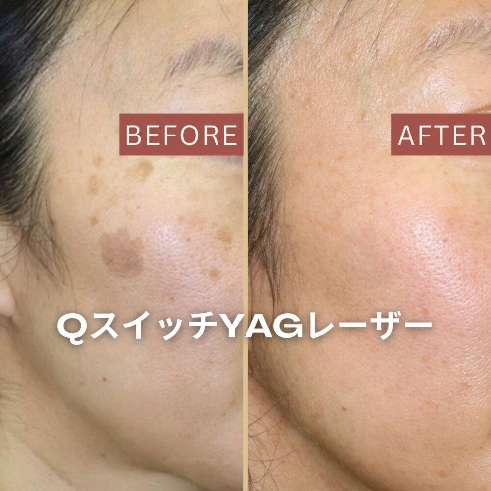 Tiêm meso trị nám có tốt hơn bắn laser không