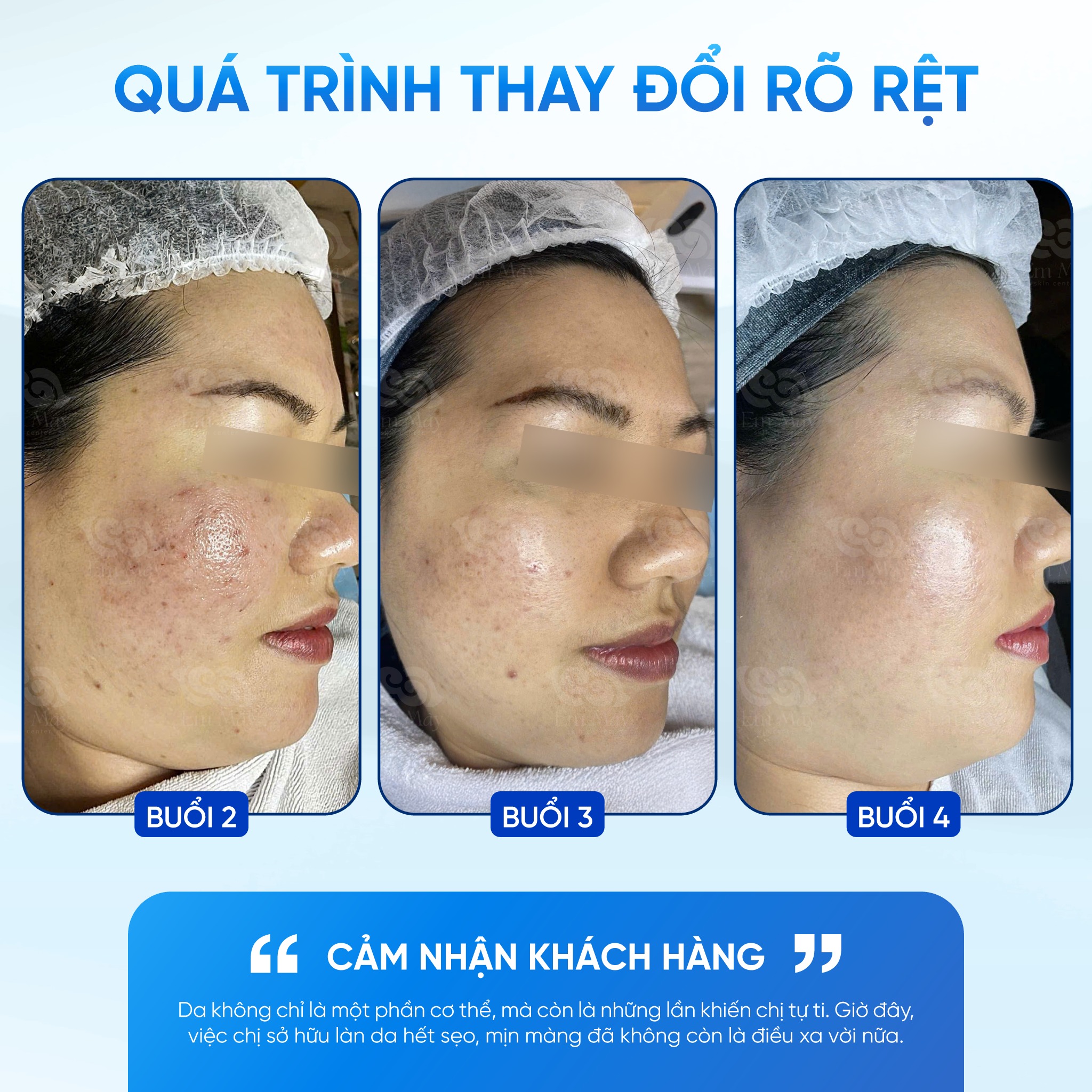 Tiêm meso trị sẹo có hiệu quả không